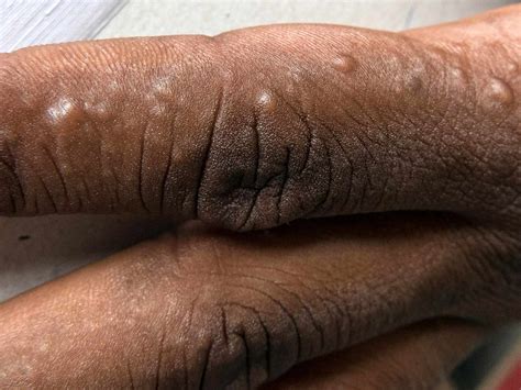 dyshidrotic eczema on black skin|More.